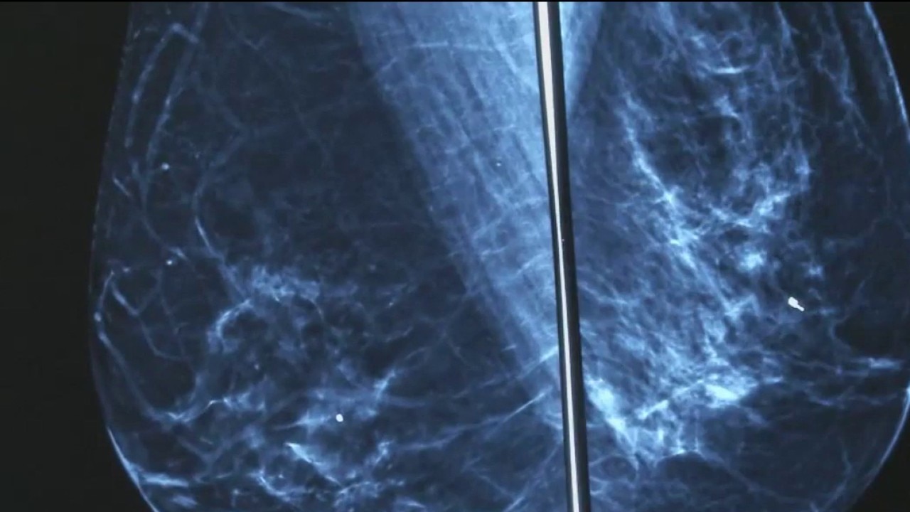 Woman receiving mammogram, highlighting dual screening for lung cancer.