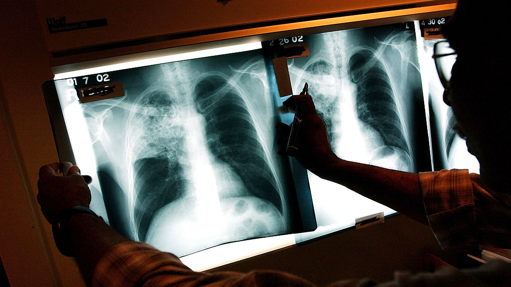 2 active tuberculosis cases traced to San Francisco strip club — KTVU FOX 2 Bay Area, Burlingame Health news